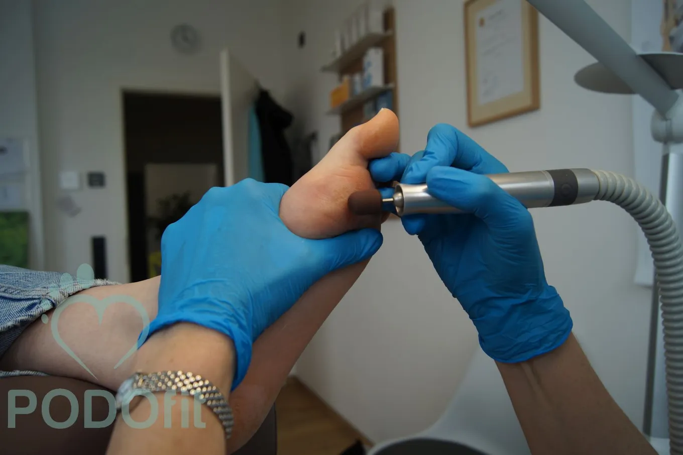 Hornhautabtragung und Druckstellenbearbeitung